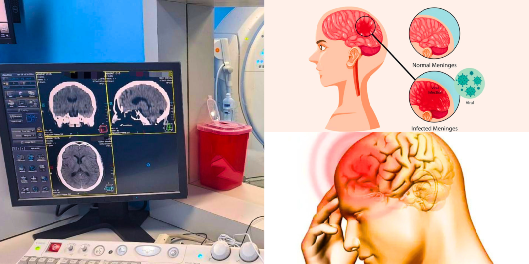 Meningitis: IMSS de Slp llama a atender infecciones persistentes